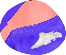 Pertes laiteuses
