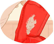 Mycose vaginale